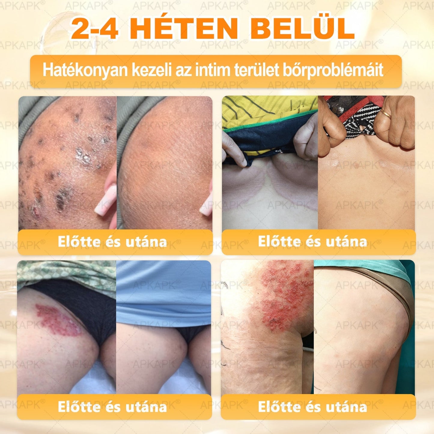 🔥 APKAPK® Méhméreg Bőr Helyreállító Krém 🔥 Magyar fejlesztés, magyarországi gyártás és szállítás