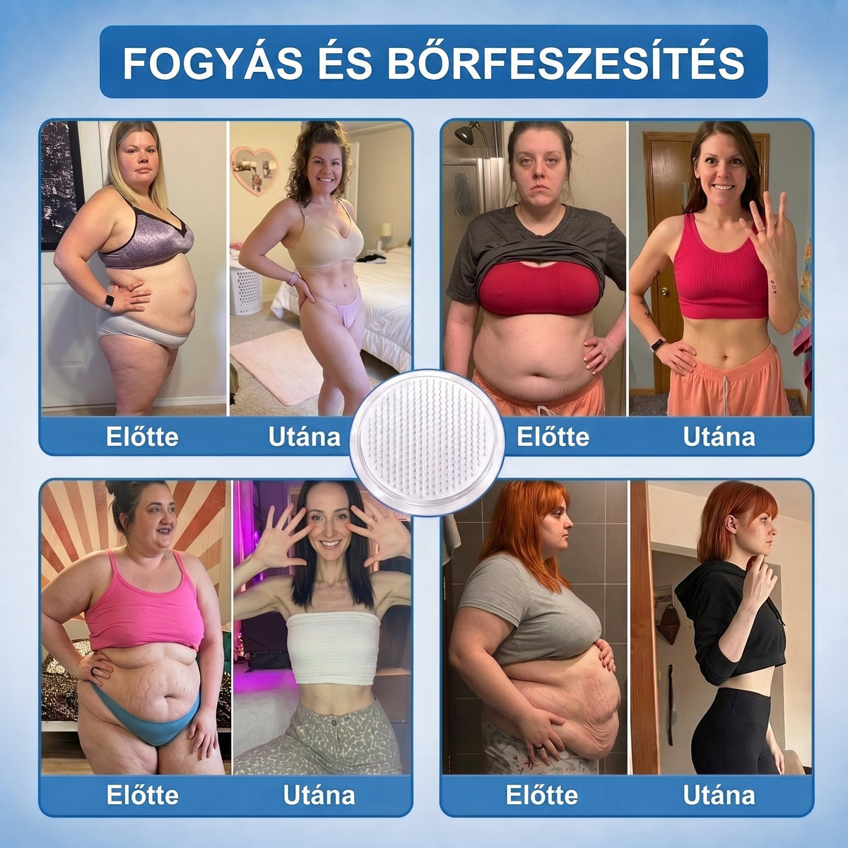FFBSI® Nano mikrotűs karcsúsító tapasz (Naponta egyszer már 28 napon belül látható változások láthatók) Alkalmas: elhízás kezelésére, szív- és érrendszeri egészségre, cukorbetegség kezelésére, alvási apnoéra és bélrendszeri problémákra🔥